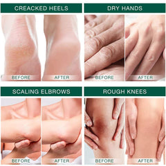 KANZA - Urea Cream for Cracked Feet,Hands with Foot File Combo Set | Callus Remover Hand Cream, Foot Cream for Dry Cracked Feet, Hands, Heels, Elbows, Nails, Knees | For Men And Women | 100g