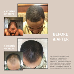 Keeps Minoxidil for Men Topical Hair Growth Solution 5%, Hair Loss Treatment - 3 Month Supply (3 x 2oz Bottles With Dropper) - For Thicker, Longer Hair - Slows Hair Loss & Promotes Hair Regrowth
