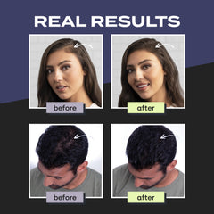 Toppik Hair Building Fibers with Premium Keratin Fibers Conceals Hair Thinning and Hair Loss for Fuller Looking Hair that Gives Completely Natural Look For Men and Women White, 27.5 Grams