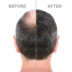 Hair-Regen Advanced 5% Minoxidil For Men Hair Regrowth Treatment for Thinning Hair - Hair Loss for Men - 6 Month Supply, Minoxidil Topical Solution So Thicker Fuller Hair Keeps Growing Amazing Results