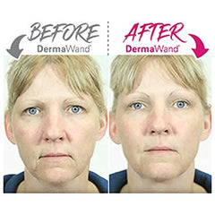 TOKEZO Derma Wand Skin Care System Massager For Wrinkles, Puffy Eyes, Non-Surgical Face Lift with Makeup Bag