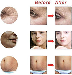 Derma Roller 4 in 1 Different Sizes with Sterile Sterilization Solution (0.5/1.0/1.5mm)