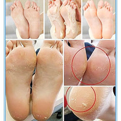 MBeauty Exfoliating Magic Foot Socks, Single Use 1 Pair Moisturizing Socks, Softens & Removes Dead Calluses, Infused With Natural Ingredients, For Soft & Refreshed Foot (Pack of 1)