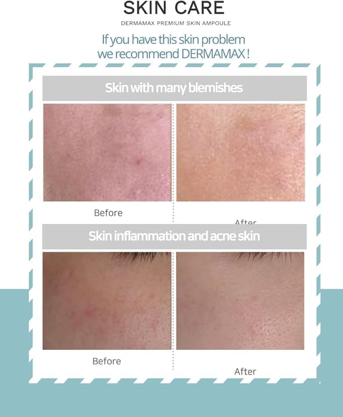 Dermamax Premium Booster kit 10 vials Professional Microneedling Serum (10 * 8 ml) Ampoules, Orginal Made in korea, Anti-acne,anti-blemish