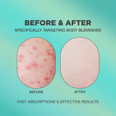 Butt Acne Cream | Buttocks Acne Lotion for Body Blemishes | Body Acne Cream Formulated with Natural Formula | Butt Acne Clearing Treatment Lotion | Butt Acne Spot Cream Targeting Stubborn Blemishes