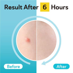 DERMA ANGEL Acne & Post Acne Patches - Hydrocolloid Pimple Care with TXA & CICA for Active Acne & Post-Inflammatory Dark Spots - Day and Night Use - UPGRADED (Post Acne - 96 Count - 1 Size)