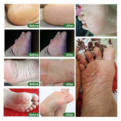 ALIVER Foot Peel Mask - 5 Pack, Exfoliating Feet Mask For Baby Soft Skin, Repair Dead Skin, Calluses, ed - Lavender