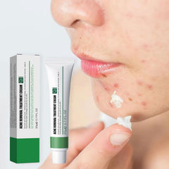 Excefore Acne Treatment Cream, 30 Day Supply, Treatment for Face with Aloe Essence, Gentle Skin Care for Acne Prone Sensitive Skin, Acne Cream Back Acne Treatment Cream for Teens & Adults, 20g Tube