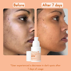 WishCare Super Bright C16 Vitamin C Serum for Oily Skin, Dry & Combination Skin -10% Vitamin C, 4% Niacinamide,1% Kojic Acid, 0.5% Ferulic Acid, Licorice & 4-n-BR- Serum For Pigmentation & Dark Spots