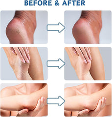 GraGra Urea Cream, 2 Pcs Urea Foot Cream, Premium Urea Foot Cream, Skin Care Moisturizer, For Feet, Hands, Heels, Elbows, Knees and More, Deep Moisturizes, Callus Remover and Soften