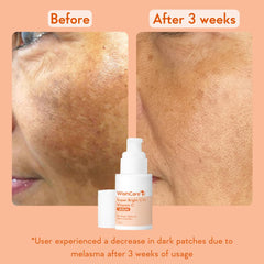 WishCare Super Bright C16 Vitamin C Serum for Oily Skin, Dry & Combination Skin -10% Vitamin C, 4% Niacinamide,1% Kojic Acid, 0.5% Ferulic Acid, Licorice & 4-n-BR- Serum For Pigmentation & Dark Spots