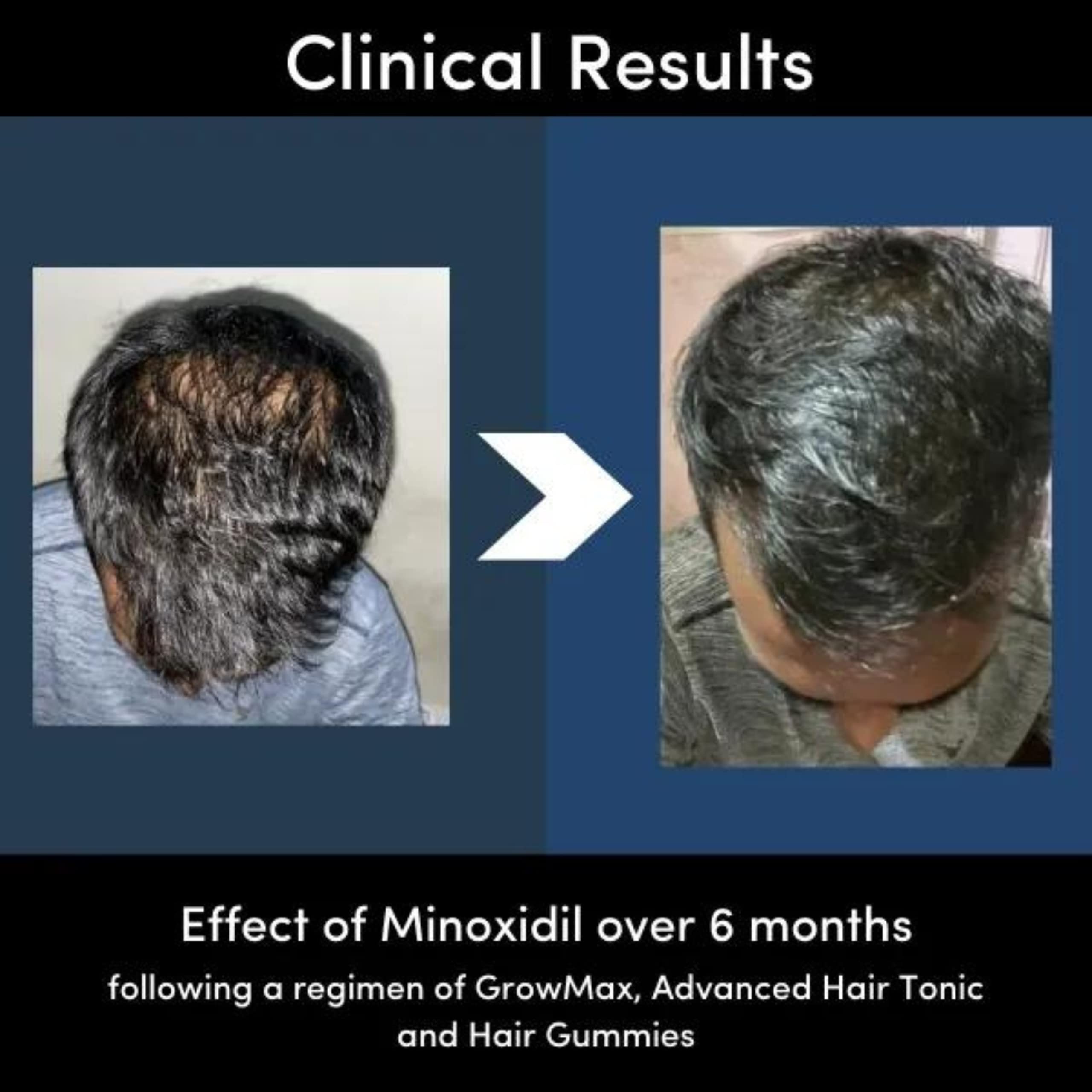 Man Matters Minoxidil 5% Solution Serum for Men with Procapil I Controls Hair Loss, Thinning I Revitalise Hair and Beard Regrowth I Alcohol Free, Non-Sticky, Unscented I Extra Strength I 60 ml