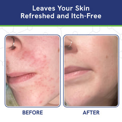 pHat 5.5 Seborrheic Dermatitis Cream with Manuka Honey, Coconut Oil and Aloe Vera