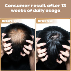 Advanced Hair Growth Serum - Anti Hair Loss Serum For Women & Men - Hair Thickening & Regrowth Formulae - Reduces Hairfall, Strengthens Roots, Boosts Volume & Length (60ml)