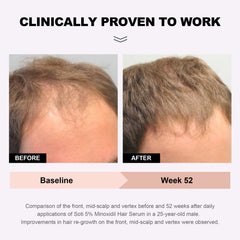 5% Minoxidil Hair Growth Serum for Hair Loss & Thinning, with Ginseng, Fo-Ti, Biotin – Thicker, Stronger Hair Regrowth & Fuller Appearance Scalp Health Treatment, 6-Month Supply (360 ml)