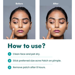 FemiSafe Acne Pimple Patch | 72 Invisible & Waterproof | Enriched with Salicylic Acid & Hydrocolloid | Spot Acne Patches for Unisex| Reduces pus overnight | Heal acne scars in 5-7 days |Sizes 8-12 mm