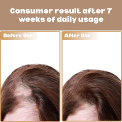 Advanced Hair Growth Serum - Anti Hair Loss Serum For Women & Men - Hair Thickening & Regrowth Formulae - Reduces Hairfall, Strengthens Roots, Boosts Volume & Length (60ml)