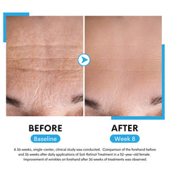 Soti 2.5% Retinol Serum, Formulated in USA! Reduces Wrinkles, Age Spots, Post-Acne Marks. Stimulates Collagen, Firm Skin, Anti Aging with Hyaluronic Acid, Niacinamide