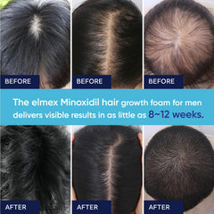 Artimore 5% Minoxidil Foam 1PCS, 5% Minoxidil for Men Foam, Minoxidil for Women Hair Growth, Minoxidil Foam for Women, Minoxidil Foam for Men Hair., Blue