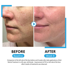 Soti 2.5% Retinol Serum, Formulated in USA! Reduces Wrinkles, Age Spots, Post-Acne Marks. Stimulates Collagen, Firm Skin, Anti Aging with Hyaluronic Acid, Niacinamide