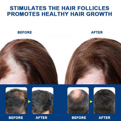 Alopecia Hair Growth Cream, 20g, Hair Regrowth Treatment for Stronger Hair