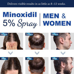 Minoxidil 5% for Men (120 ML), Advanced Minoxidil Spray with Provitamin B5 and Castor Seed Extract, Minoxidil Extract Serum for Hair Loss, Beard Restoration