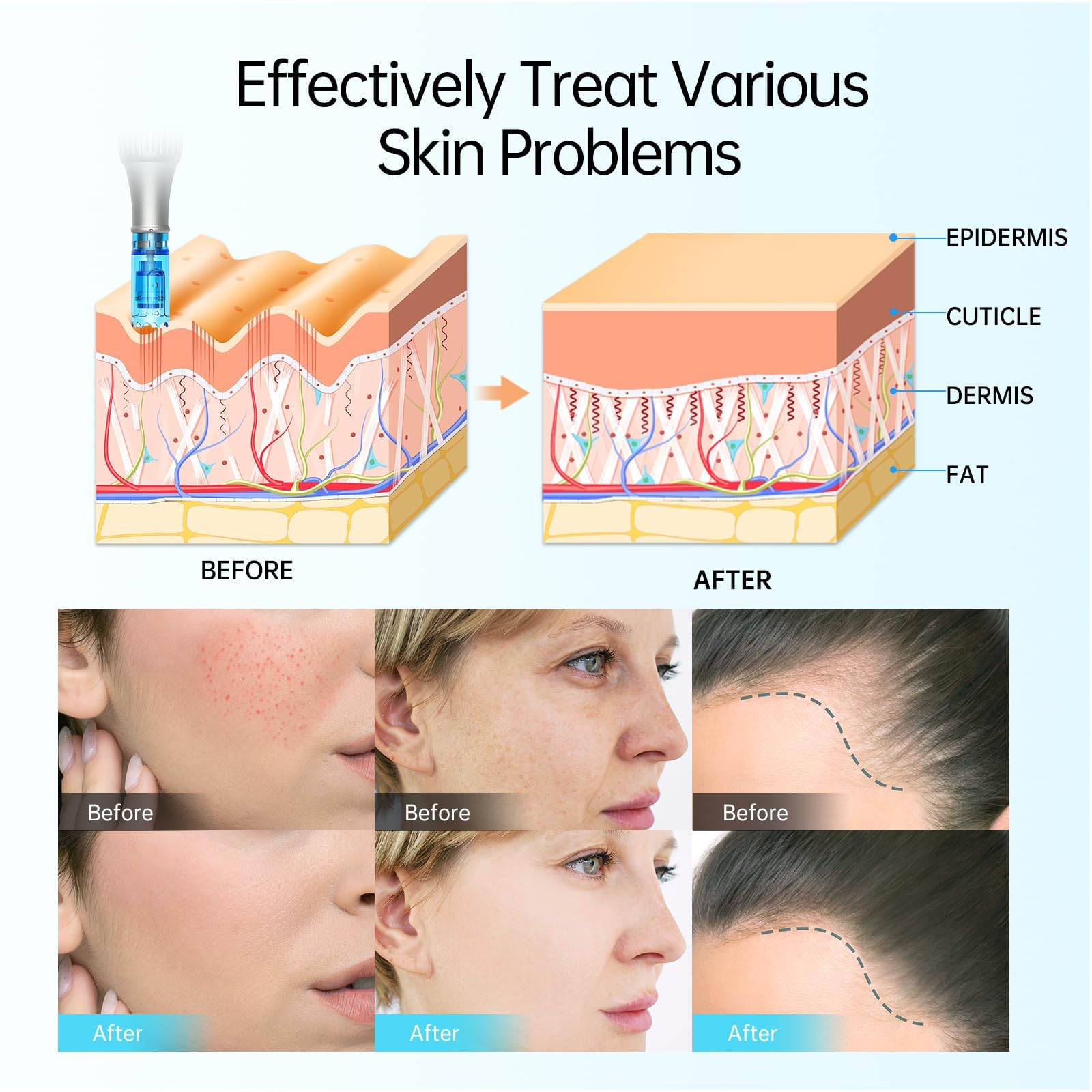 Dr.Pen Derma Pen M8S Microneedling pen Wireless Micro Needling Skin Care Tool Kit for Anti-aging Acne Scars Wrinkles with 5 pcs 18 pin + 5 pcs 36 pin Cartridges