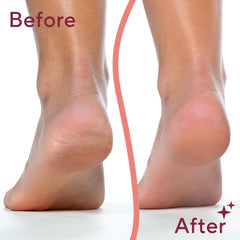 Finishing Touch Flawless Pedi Electronic Tool File and Callus Remover, Pedicure
