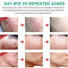 Excefore Acne Treatment Cream, 30 Day Supply, Treatment for Face with Aloe Essence, Gentle Skin Care for Acne Prone Sensitive Skin, Acne Cream Back Acne Treatment Cream for Teens & Adults, 20g Tube