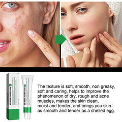 Excefore Acne Treatment Cream, 30 Day Supply, Treatment for Face with Aloe Essence, Gentle Skin Care for Acne Prone Sensitive Skin, Acne Cream Back Acne Treatment Cream for Teens & Adults, 20g Tube