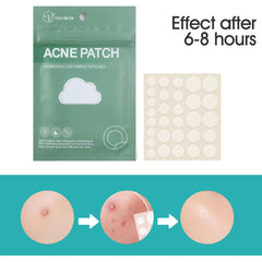 Acne Pimple Patches, Hydrocolloid Acne Patches with Tea Tree Oil,Salicylic Acid & Calendula Oil,Pimple Patch for Face, Zit Patches,Pimple Stickers(150 Count)