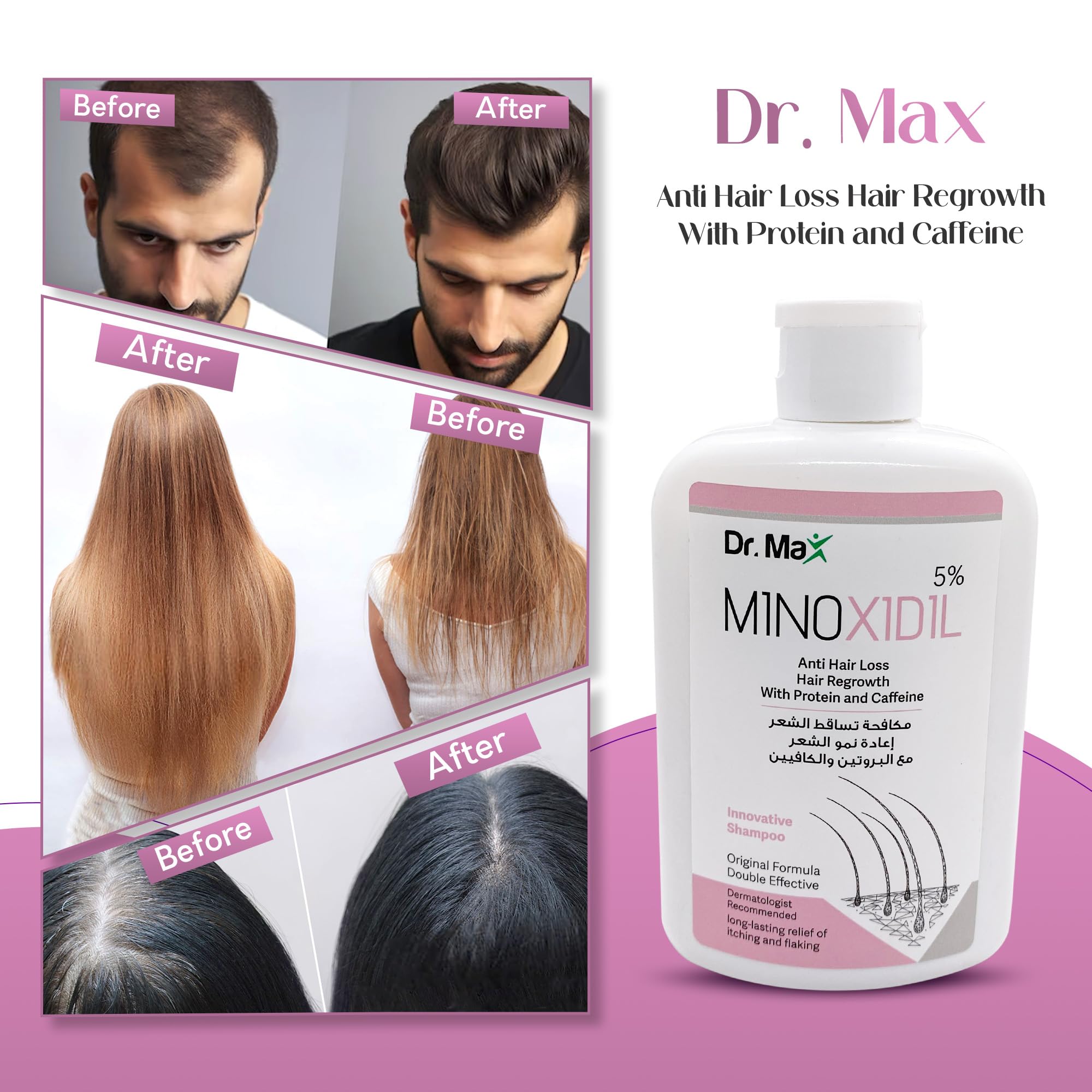 Dr Max Minoxidil 5% Anti Hair Loss Shampoo, Hair Regrowth With Protein Caffeine Long Lasting Relife of Itching And Flaking