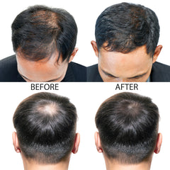 Hair-Regen Advanced 5% Minoxidil For Men Hair Regrowth Treatment for Thinning Hair - Hair Loss for Men - 6 Month Supply, Minoxidil Topical Solution So Thicker Fuller Hair Keeps Growing Amazing Results